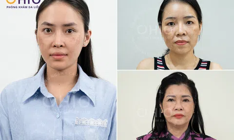 Trị nám, tàn nhang tại Vinh với phác đồ PBS Premium tại Phòng khám da liễu OHIO