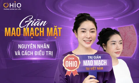 Giãn mao mạch mặt, nguyên nhân và cách điều trị