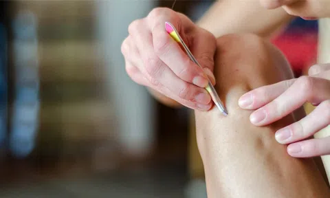 Nhổ lông mọc ngược, người đàn ông 39 tuổi nhập viện chỉ còn 4% cơ hội sống sót