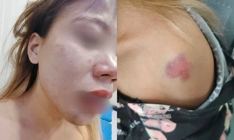 Cô gái lên mạng xã hội cầu cứu vì bị chồng bạo hành để lại những vết thương khắp người