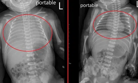 Bé sơ sinh chỉ khóc 2 tiếng rồi bất động: Người cha hoảng loạn, bác sĩ chỉ ra 'thủ phạm': Cha mẹ tuyệt đối không được bỏ qua