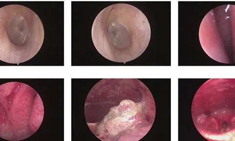 Nuốt khó, sụt 5kg trong 1 tháng: Phát hiện cùng lúc hai bệnh ung thư nguy hiểm