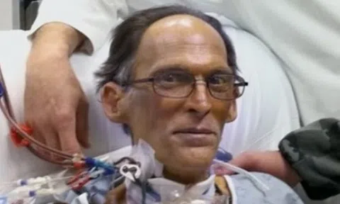 Người đàn ông đầu tiên trên thế giới sống không tim, không mạch đập