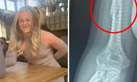 Rùng mình khoảnh khắc cô gái trẻ gãy xương khi chơi vật tay với người đàn ông