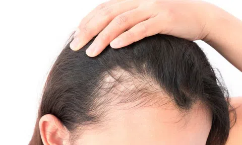 Rụng tóc, đau đầu liên tục người phụ nữ đi khám thì phát hiện căn bệnh đáng sợ