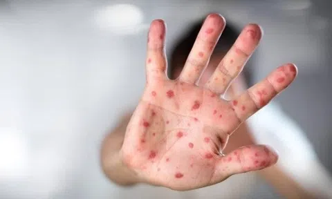 Dịch tay chân miệng vào mùa, 3 thứ cha mẹ cần nằm lòng để bảo vệ trẻ