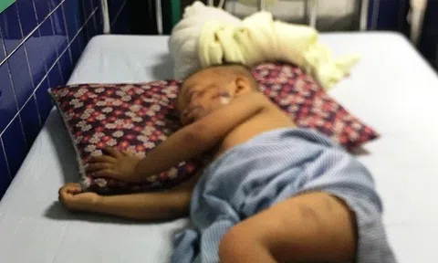 Bé trai 2 tuổi bị chó becgie cắn phải nhập viện cấp cứu