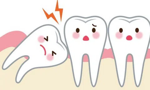 Tại sao hay "mọc ngu" mà chúng vẫn được gọi là "răng khôn"?