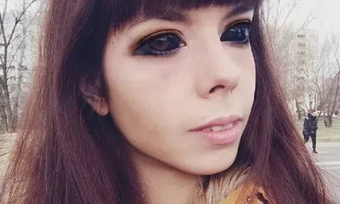 Cô gái 25 tuổi bị mù vì đi xăm đen 2 nhãn cầu mắt để có vẻ ngoài giống thần tượng