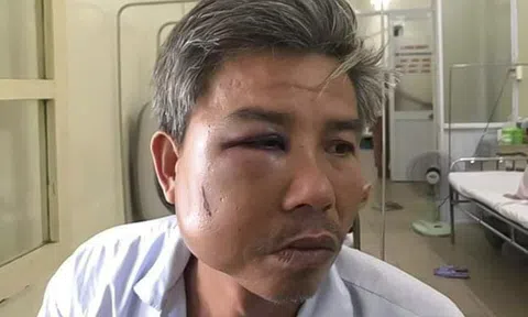 Khởi tố ông chủ quán "Bố già" đánh công nhân gãy quai hàm