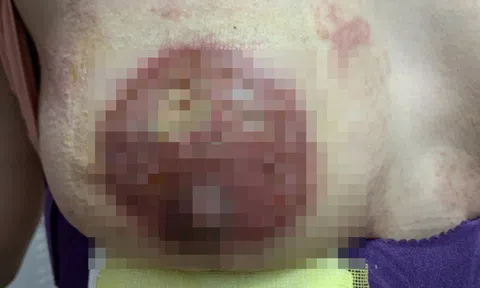 Ham làm đẹp giá rẻ, hai người phụ nữ nhập viện khẩn cấp sau khi nâng ngực