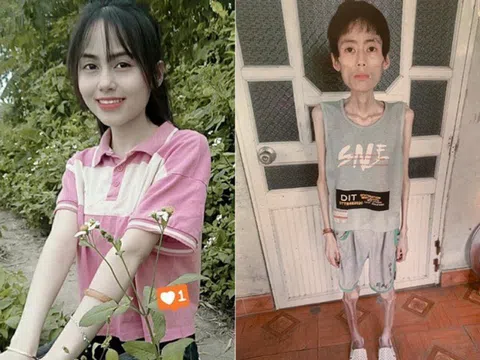 Cô gái Hưng Yên nặng 18kg sau nhiều năm bỏ ăn cơm để giảm cân, bác sĩ cảnh báo: Đừng khuyên nhau cắt tinh bột!