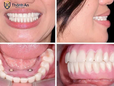 Nha khoa Thành An: Nơi trao gửi niềm tin cho hành trình cấy ghép Implant thành công