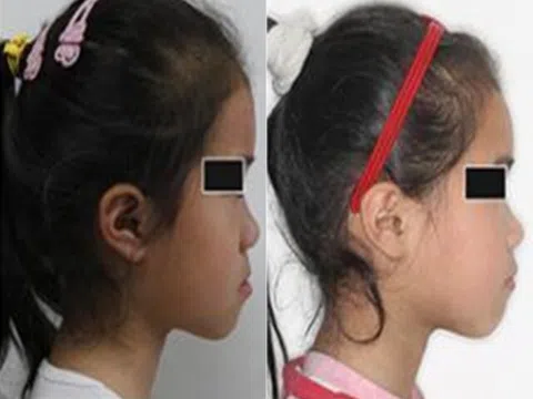 Con gái lúc nhỏ đẹp nhưng càng lớn càng móm, đến bệnh viện bác sĩ nói nguyên nhân khiến gia đình suy sụp