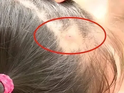 Mẹ phát hiện trên đầu con xuất hiện một lỗ sâu kỳ lạ liền đưa đi khám, đến bệnh viện bác sĩ nói: “Đứa trẻ quá may mắn”