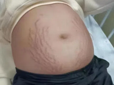 Mẹ nghi con gái lớp 3 mang thai vì bụng to bất thường, đi khám bác sĩ kết luận 5 chữ khiến mẹ gục ngã