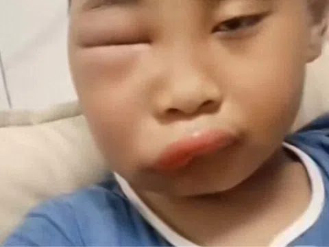 Gửi con về quê nghỉ hè với ông bà, ngày về đón mẹ tá hoả khi mặt đứa trẻ biến dạng