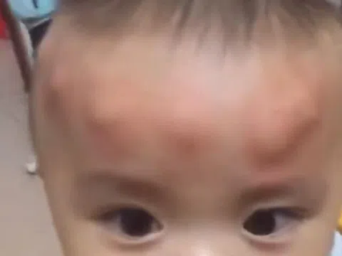 Con trai 2 tuổi ngủ dậy trên đầu liền xuất hiện nhiều khối u bất thường, người mẹ tá hoả khi biết nguyên nhân