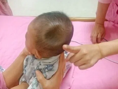 Bé trai 8 tháng tuổi gây xót xa khi đầu bị lõm xuống như một “chiếc hố”, chỉ vì sơ suất nhỏ của bố mẹ