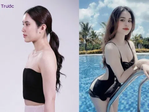 Treo sa trễ tự thân 3D Scarless: Vòng 1 săn chắc, ít sẹo, tiết kiệm chi phí dưới bàn tay Dr Robert Luân Nguyễn