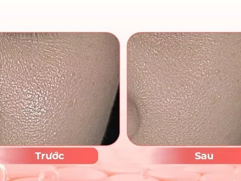 Điều trị lão hóa sắc tố da tuổi trung niên