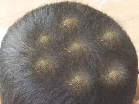 Mẹ phát hiện trên đầu con xuất hiện 7 vòng xoáy kỳ lạ, lo lắng đưa đến viện khám, bác sĩ thốt lên: Thật hiếm gặp!