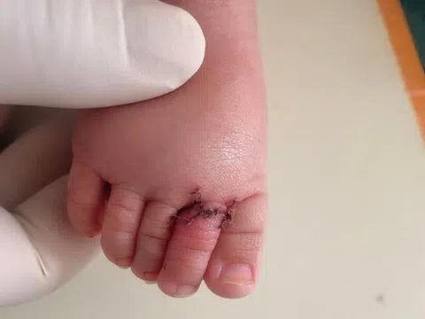 Bé trai 3 tháng tuổi suýt mất 1 ngón chân khi ngủ dậy, nghe bác sĩ nói phẫu thuật gấp, người mẹ ngập trong nước mắt