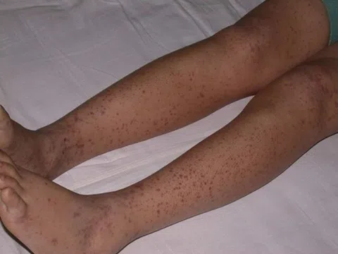 Tắm cho con gái, mẹ phát hiện chân đứa trẻ nổi loạt đốm đỏ, kết quả khám khiến gia đình đau khổ