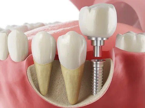 Trồng răng Implant miễn phí giá rẻ có nên không?