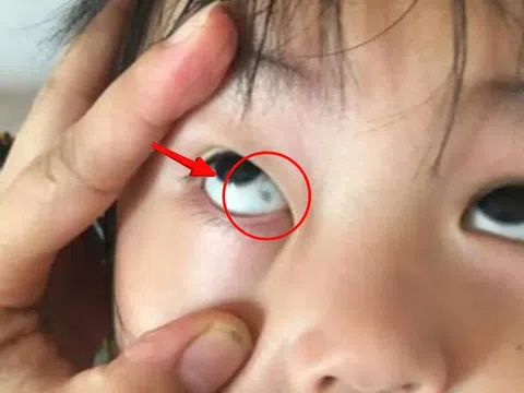 Phát hiện đốm đen trong tròng mắt con, gia đình hoang mang nhanh chóng cho bé nhập viện và cái kết không ngờ