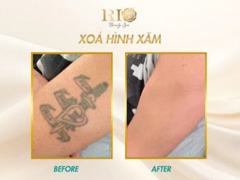 Xóa hình xăm không để lại sẹo và bí mật đằng sau