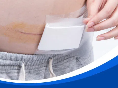 Gạc tiên tiến Hetis – Giải pháp chăm sóc vết mổ sau sinh, phòng ngừa sẹo xấu
