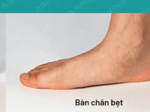 Hội chứng bàn chân bẹt: chữa trị sớm giúp con tự tin đến trường