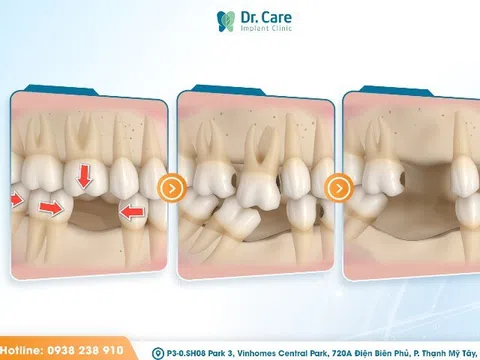 Mất răng số 7 và hậu quả khó lường! trồng răng implant số 7 giá bao nhiêu?