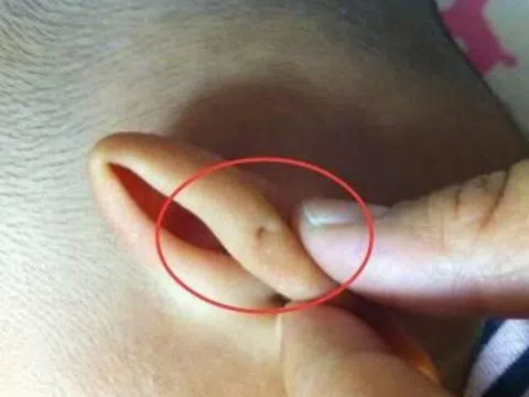 Mẹ phát hiện tai con trai có một lỗ nhỏ, vui mừng tưởng phúc tướng, không ngờ vài ngày sau gặp hoạ