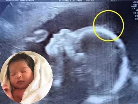 Đến viện siêu âm, mẹ bầu giật mình thấy điểm lạ trên đầu con, cái kết bé gái sinh ra đã nổi tiếng vì quá xinh