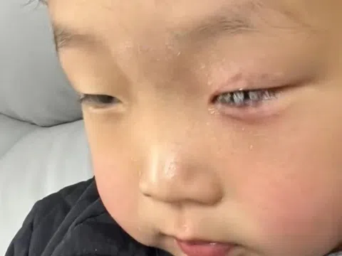 Con bị keo 502 bắn vào mắt, bố nhẹ nhàng đổ thêm một thứ, bác sĩ khen: Hiếm có người thông minh như anh!