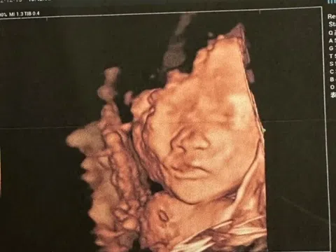 Siêu âm thấy con nhoẻn miệng cười, bố khen đáng yêu quá, bác sĩ: "Em bé không ổn, mẹ chuẩn bị tinh thần"