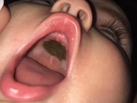 Mẹ phát hoảng thấy miệng con xuất hiện đốm đen lạ, đến bệnh viện nghe bác sĩ chúc mừng mà xấu hổ