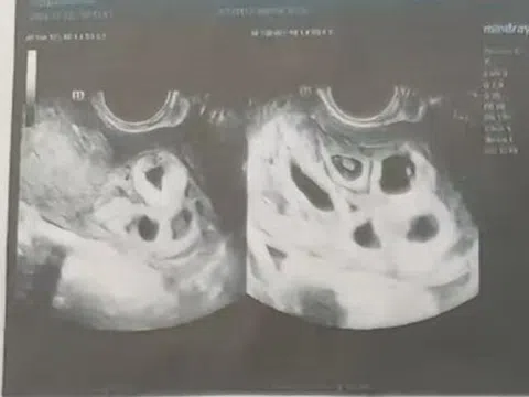 Đến bệnh viện chữa hiếm muộn, cô gái 25 tuổi sốc nặng khi nghe bác sĩ kết luận: Đang mang thai 9 con