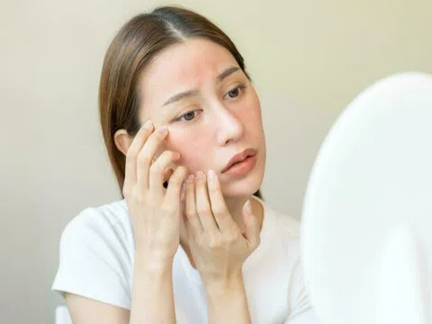 Ngứa râm ran ngoài da tưởng do thời tiết lạnh, không ngờ lại trở thành “cơn ác mộng” với cô gái trẻ ở Hà Nội