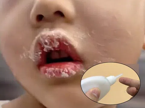 Tưởng keo 502 là son, bé gái bôi lên môi liền bị dính chặt, mẹ tưới thêm 1 thứ được BS khen: Thông minh quá!