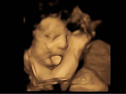 Siêu âm thấy thai nhi thè lưỡi, vợ chồng trẻ khen: "Quá đáng yêu", bác sĩ lại lắc đầu nói: "Chia buồn cùng gia đình"