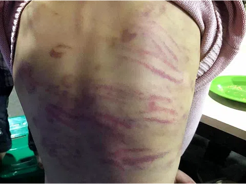 Vụ bé gái ở Hà Nội nghi bị mẹ ruột và người tình bạo hành: Xót lòng lời kể của nạn nhân