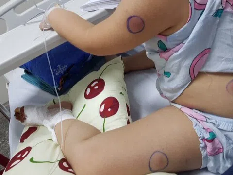 Bé 6 tuổi nhiễm vi khuẩn "ăn thịt người" sau khi bị gà mổ vào chân