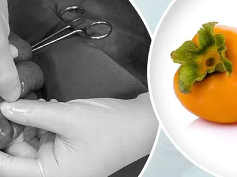Tắc ruột vì ăn loại quả quen thuộc, cô gái 23 tuổi phải nhập viện gấp