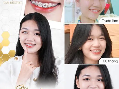 Niềng răng tại Tấm Dentist - Trào lưu làm đẹp mới của giới trẻ