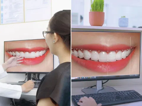 Xu hướng răng sứ đẹp, an toàn với công nghệ mới tại Nha Khoa Kim