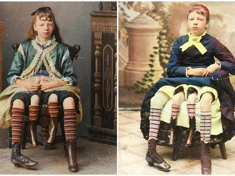 Sự thật kinh ngạc về cô gái 4 chân, 2 “vùng kín” khiến y học thế giới kinh ngạc