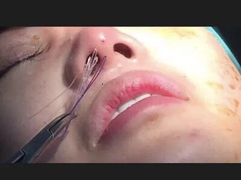 Cô gái hoại tử mũi vì tay nghề của bác sĩ mổ "dạo"